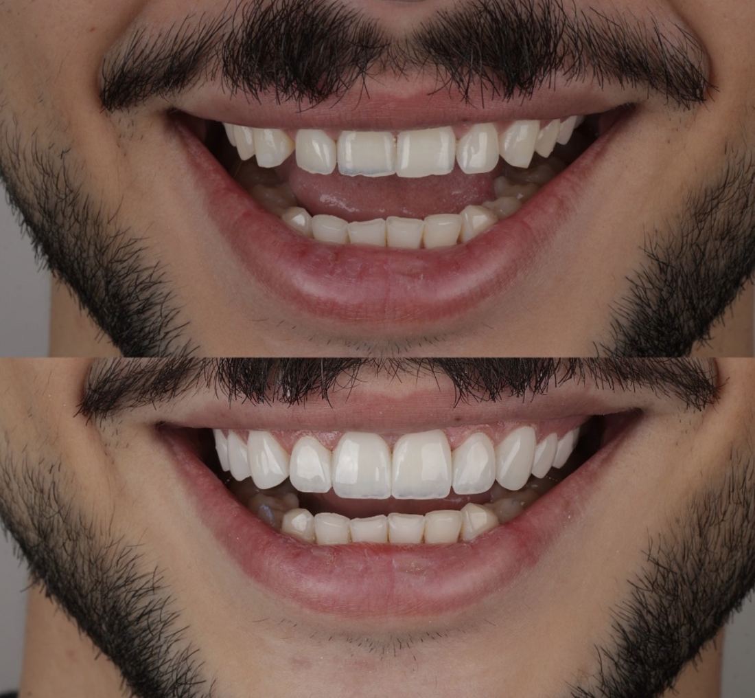 Antes e depois em close do sorriso