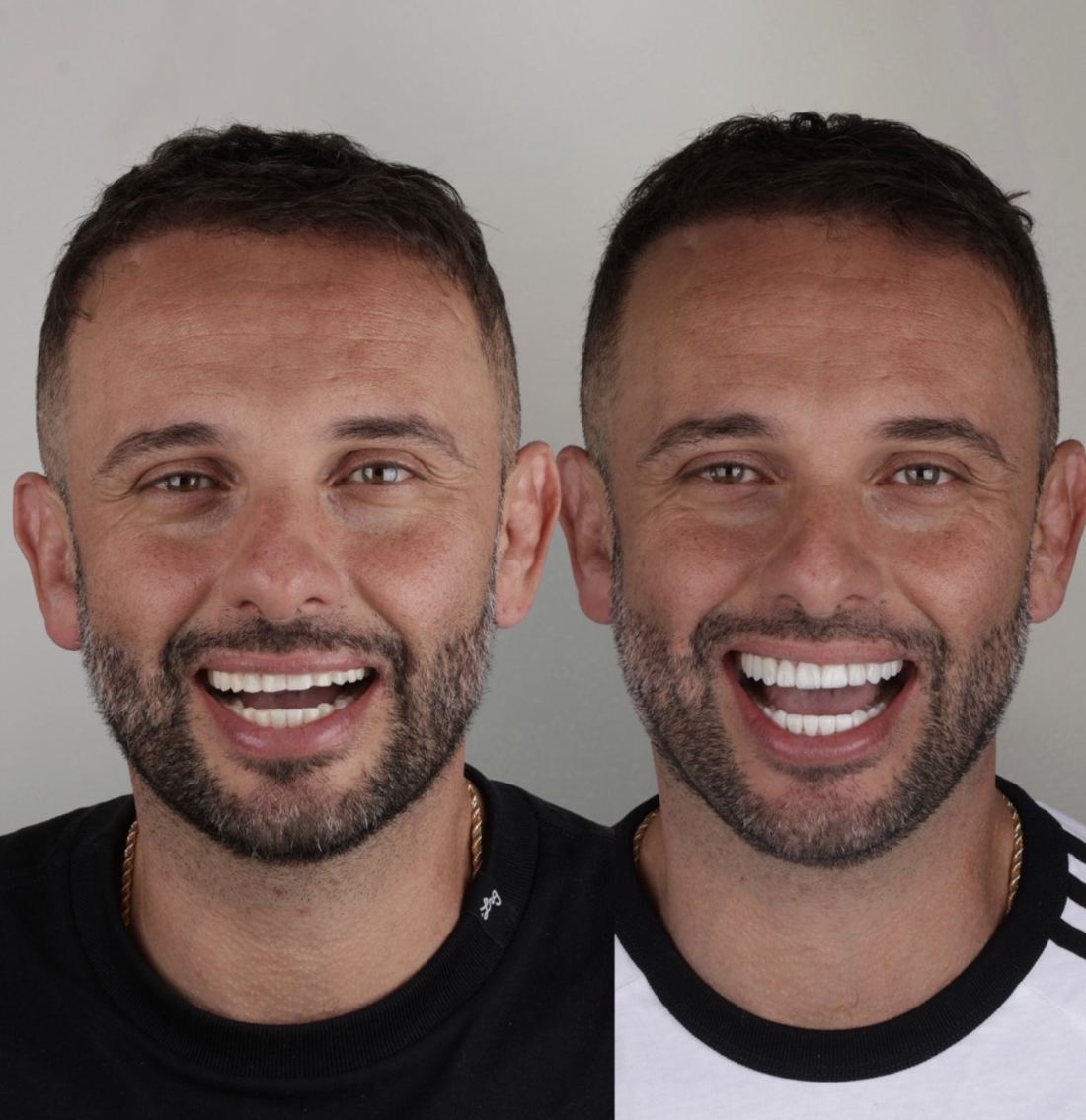 Antes e depois de lentes em resina, paciente homem