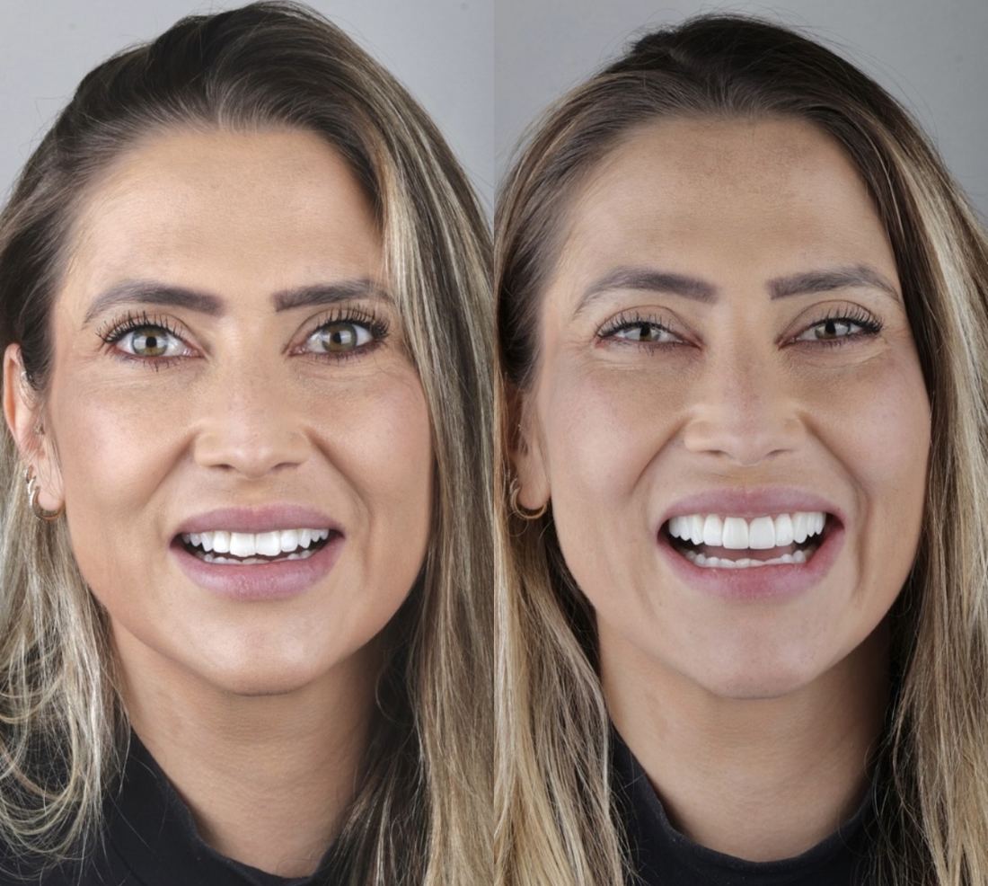 Antes e depois de lentes em resina, paciente mulher