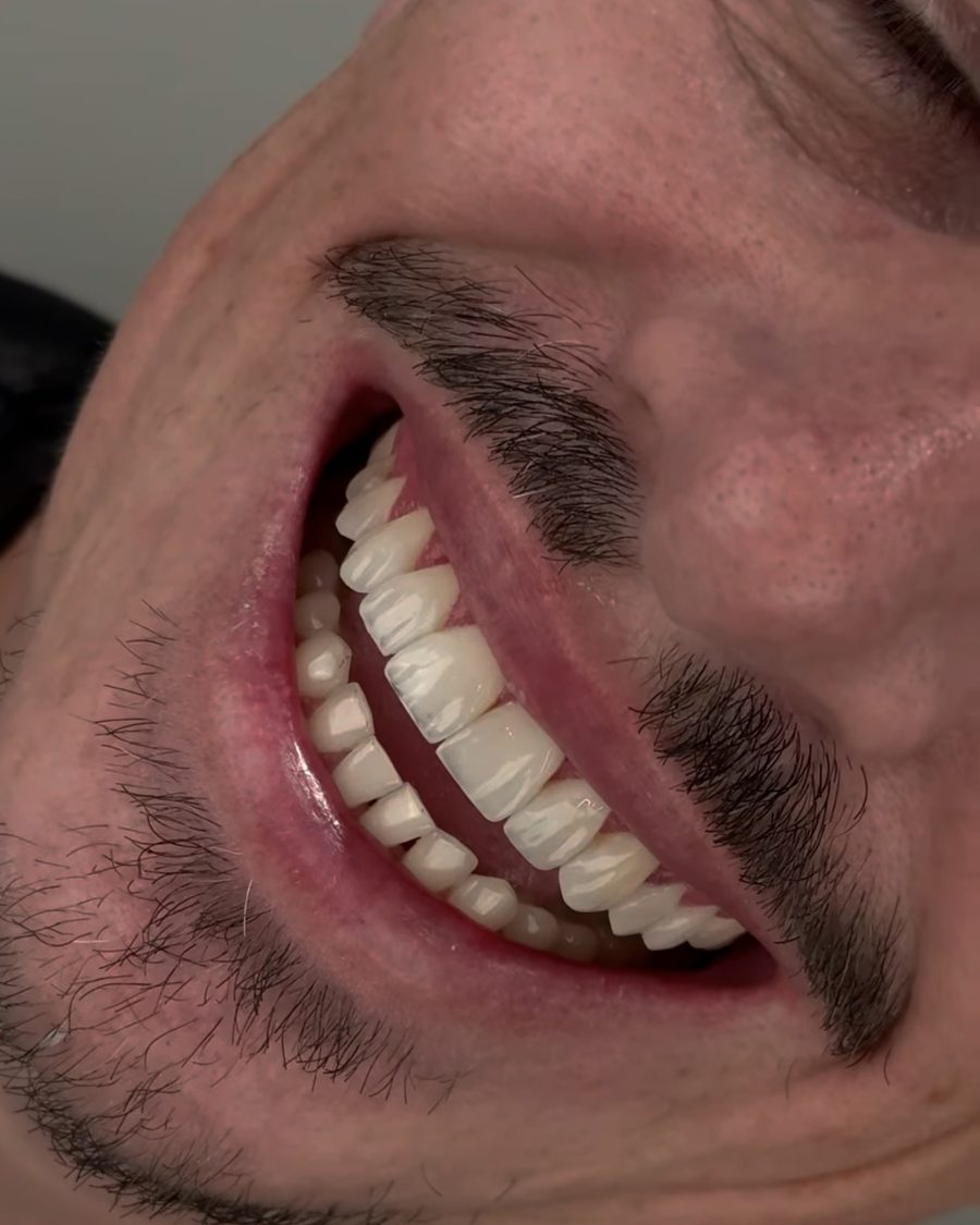 Depois: sorriso com lentes em resina